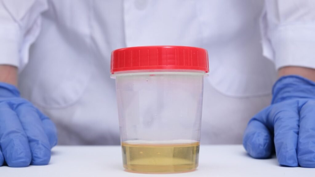 Urina espumosa é sinal de doença renal? 2 Urina espumosa pode ser sinal de doença renal?